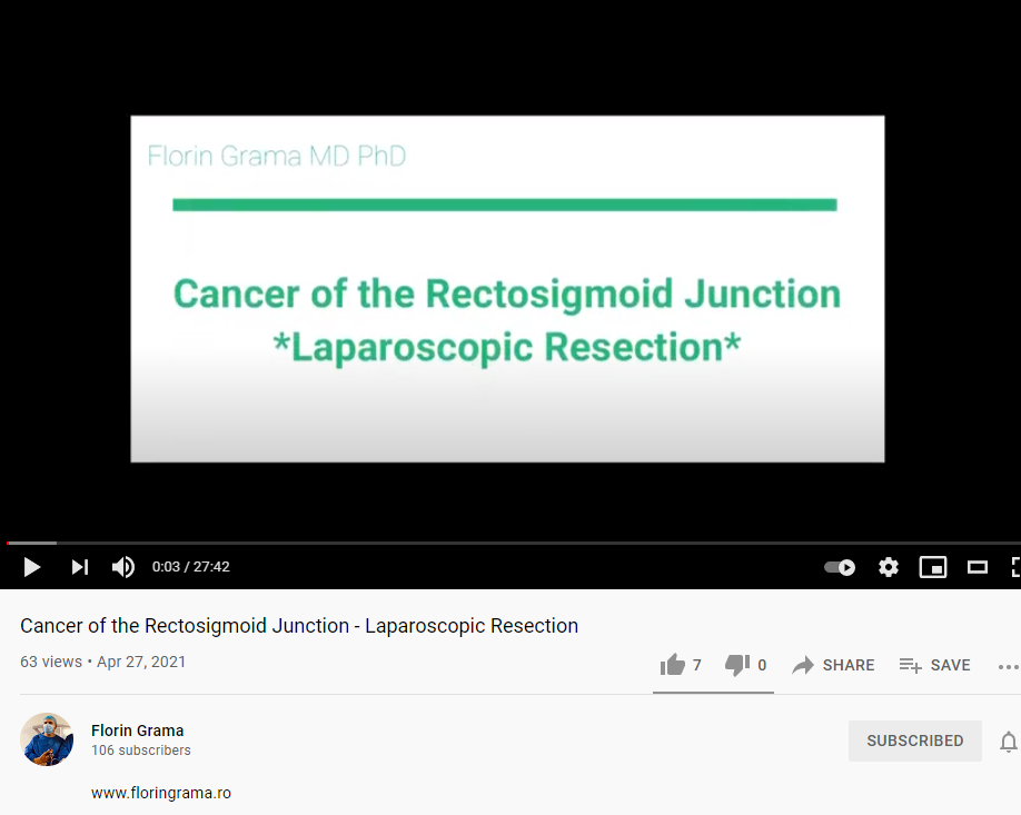 Cancerul jonctiunii rectosigmoidiene - rezectie laparoscopica