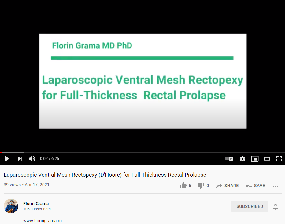 Prolaps rectal full-thickness – Rectopexia Ventrala Laparoscopica cu plasa (mesa) – D’Hoore